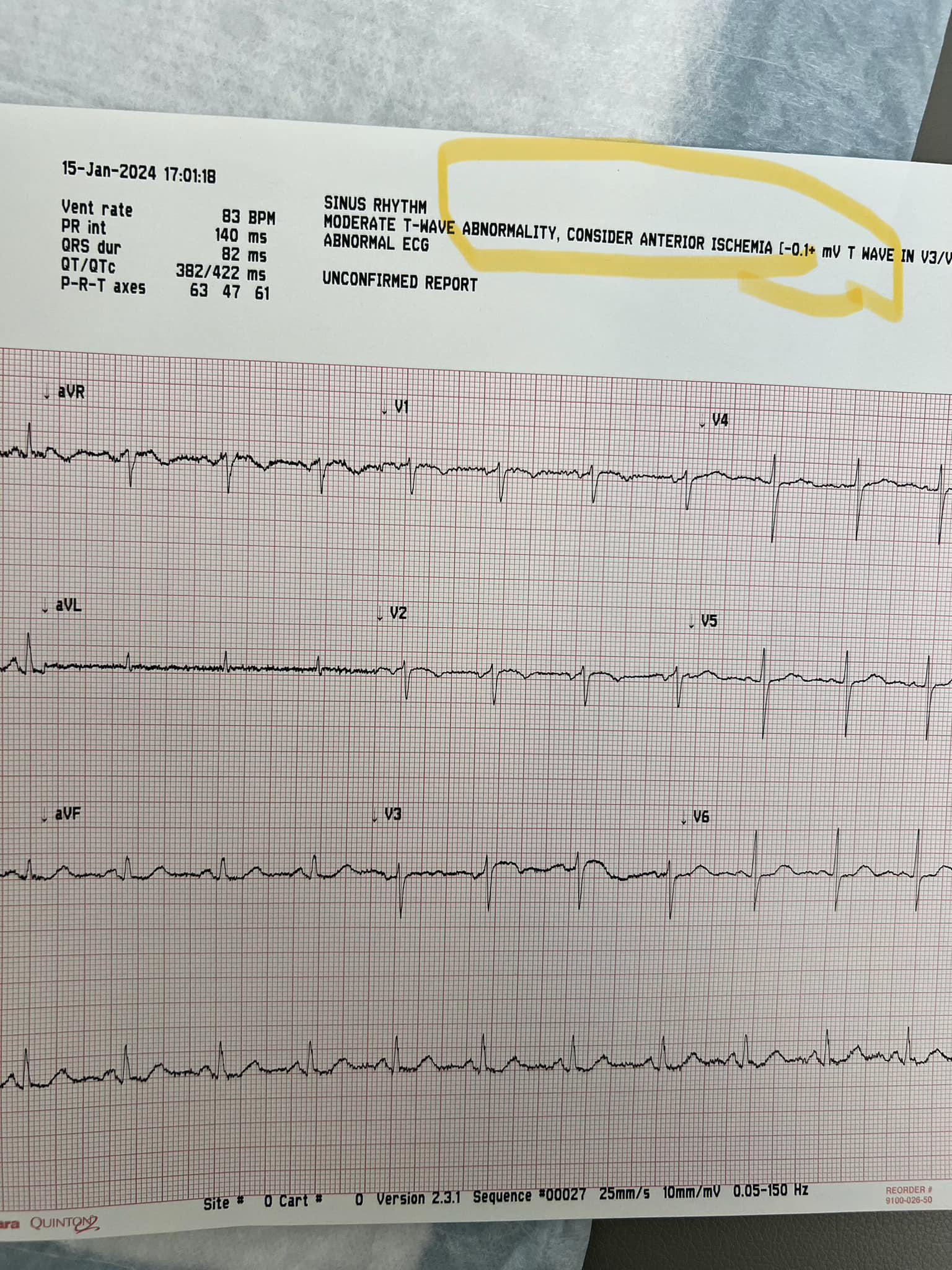 Elite NP has great faith in her new EKG machine's ability to interpret EKGs